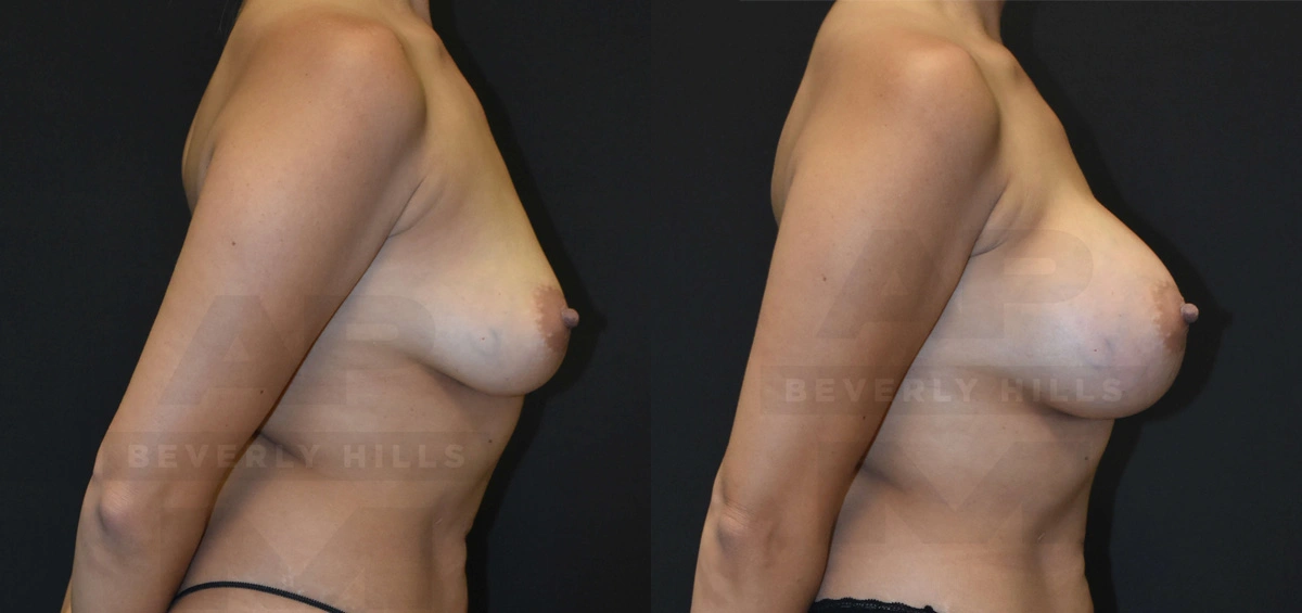 Real Patient Results of Dr. Andre P. Marshall providing Plastic Surgery services to his Beverly Hills & Los Angeles patients.