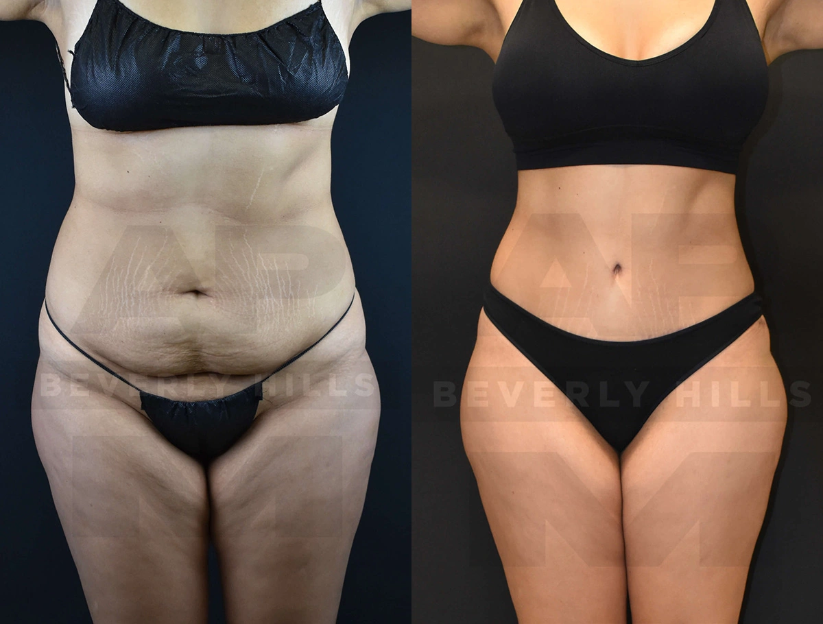 Real Patient Results of Dr. Andre P. Marshall providing Plastic Surgery services to his Beverly Hills & Los Angeles patients.