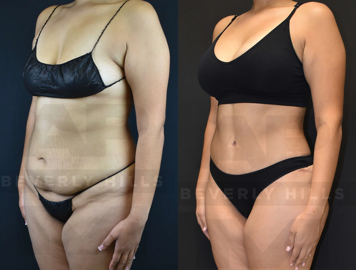 Real Patient Results of Dr. Andre P. Marshall providing Plastic Surgery services to his Beverly Hills & Los Angeles patients.