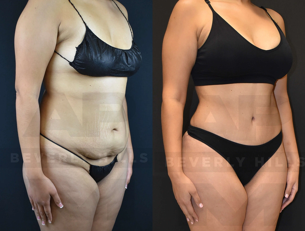 Real Patient Results of Dr. Andre P. Marshall providing Plastic Surgery services to his Beverly Hills & Los Angeles patients.