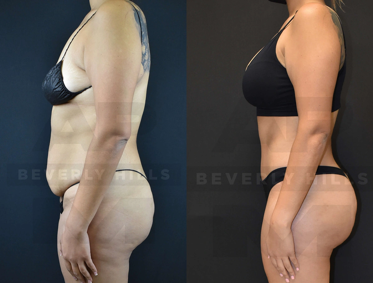 Real Patient Results of Dr. Andre P. Marshall providing Plastic Surgery services to his Beverly Hills & Los Angeles patients.