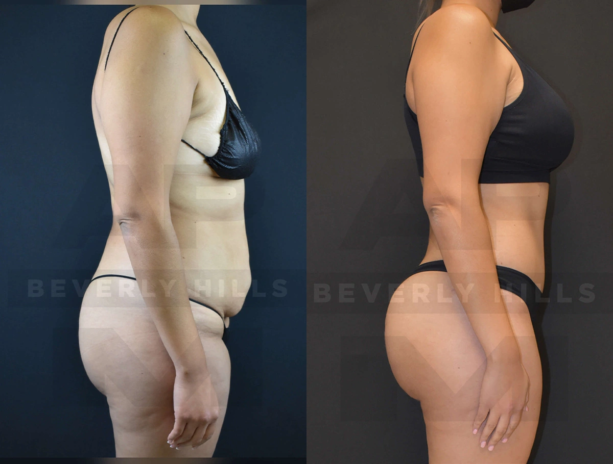 Real Patient Results of Dr. Andre P. Marshall providing Plastic Surgery services to his Beverly Hills & Los Angeles patients.