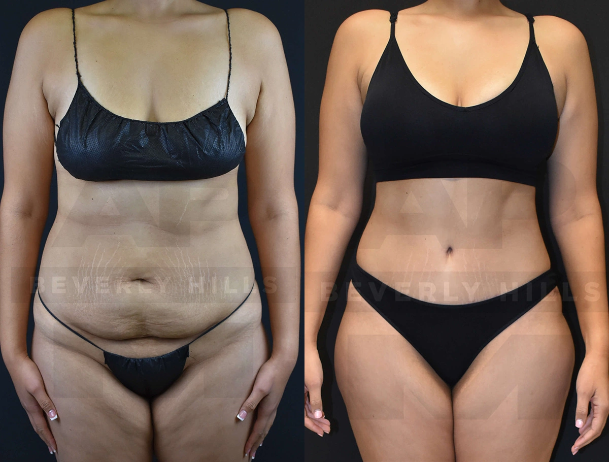 Real Patient Results of Dr. Andre P. Marshall providing Plastic Surgery services to his Beverly Hills & Los Angeles patients.