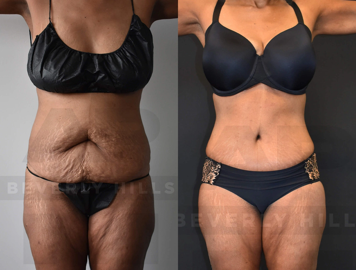 Real Patient Results of Dr. Andre P. Marshall providing Plastic Surgery services to his Beverly Hills & Los Angeles patients.