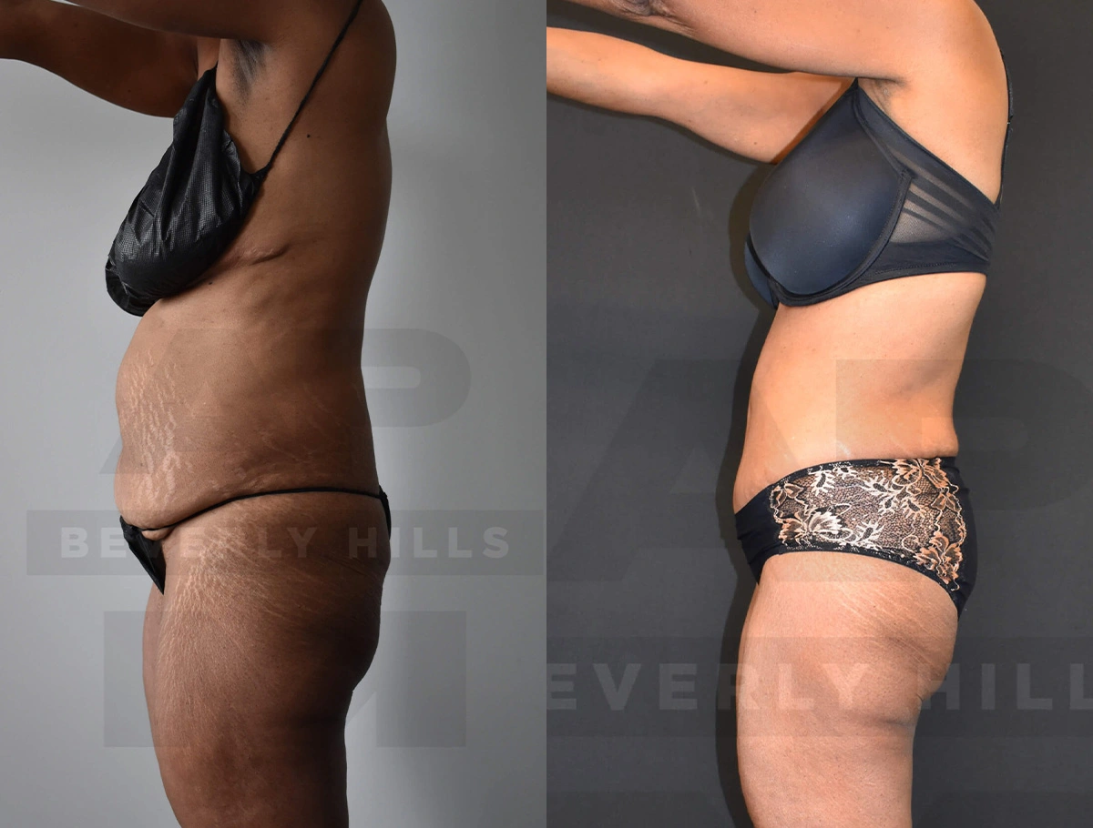 Real Patient Results of Dr. Andre P. Marshall providing Plastic Surgery services to his Beverly Hills & Los Angeles patients.