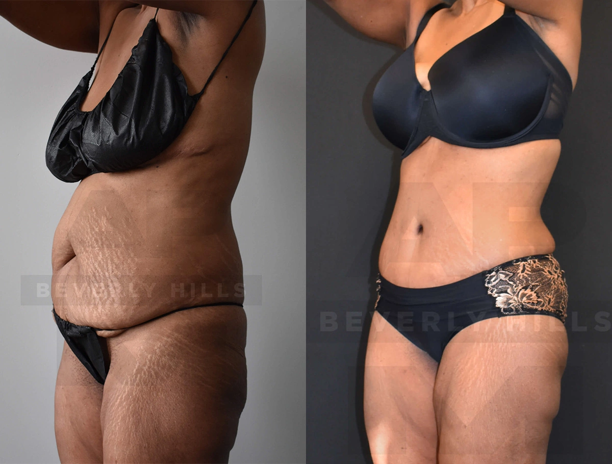 Real Patient Results of Dr. Andre P. Marshall providing Plastic Surgery services to his Beverly Hills & Los Angeles patients.