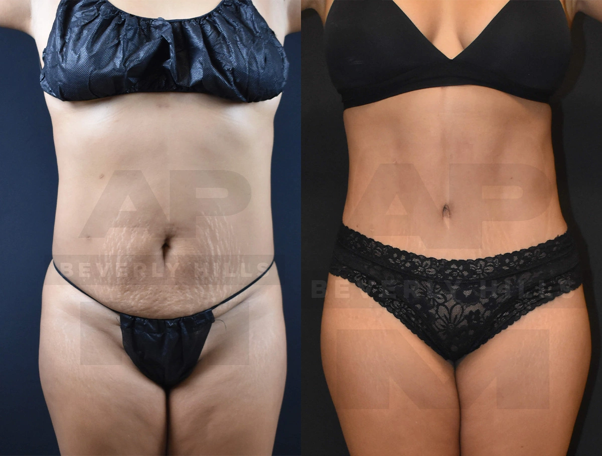 Real Patient Results of Dr. Andre P. Marshall providing Plastic Surgery services to his Beverly Hills & Los Angeles patients.