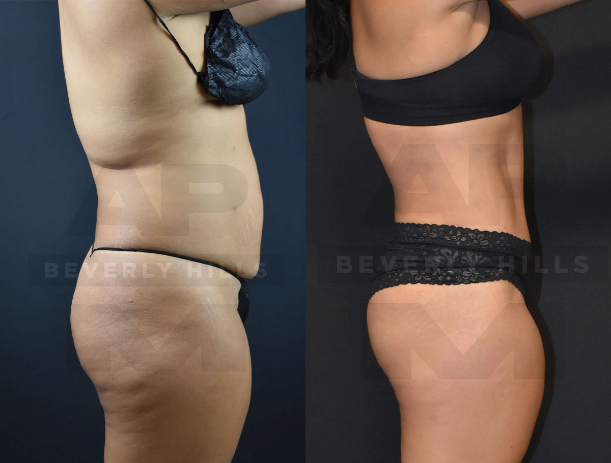 Real Patient Results of Dr. Andre P. Marshall providing Plastic Surgery services to his Beverly Hills & Los Angeles patients.