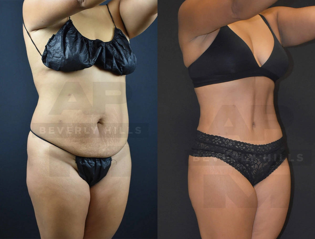 Real Patient Results of Dr. Andre P. Marshall providing Plastic Surgery services to his Beverly Hills & Los Angeles patients.