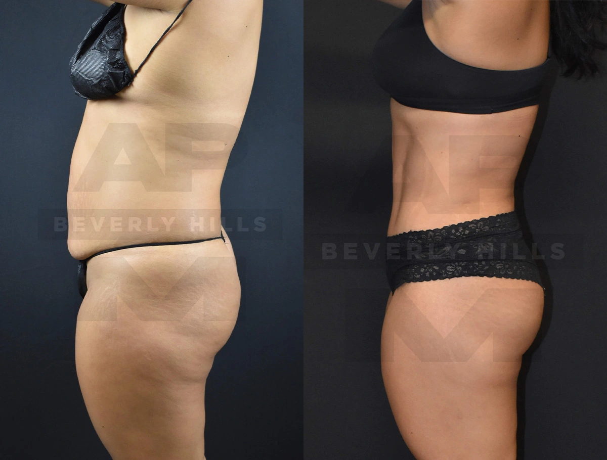 Real Patient Results of Dr. Andre P. Marshall providing Plastic Surgery services to his Beverly Hills & Los Angeles patients.