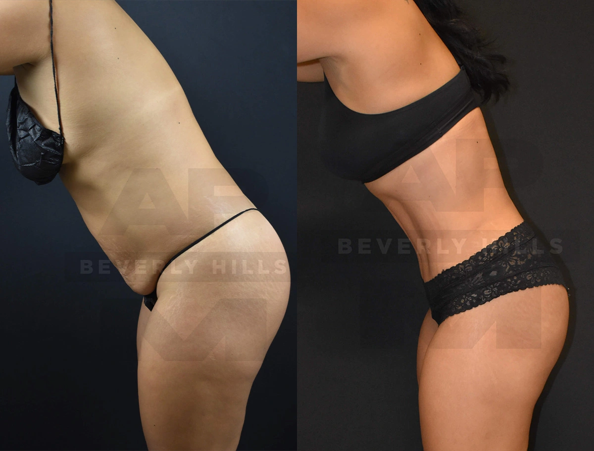 Real Patient Results of Dr. Andre P. Marshall providing Plastic Surgery services to his Beverly Hills & Los Angeles patients.