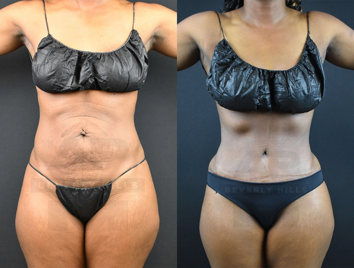 Real Patient Results of Dr. Andre P. Marshall providing Plastic Surgery services to his Beverly Hills & Los Angeles patients.