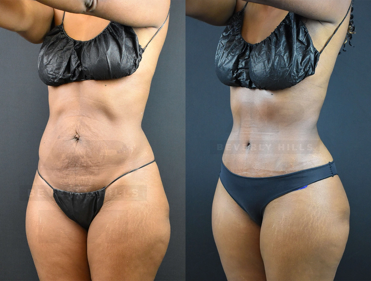 Real Patient Results of Dr. Andre P. Marshall providing Plastic Surgery services to his Beverly Hills & Los Angeles patients.