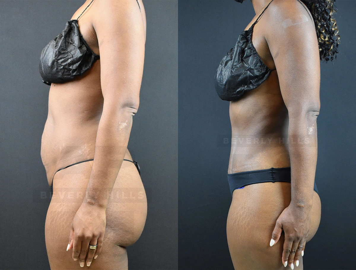 Real Patient Results of Dr. Andre P. Marshall providing Plastic Surgery services to his Beverly Hills & Los Angeles patients.