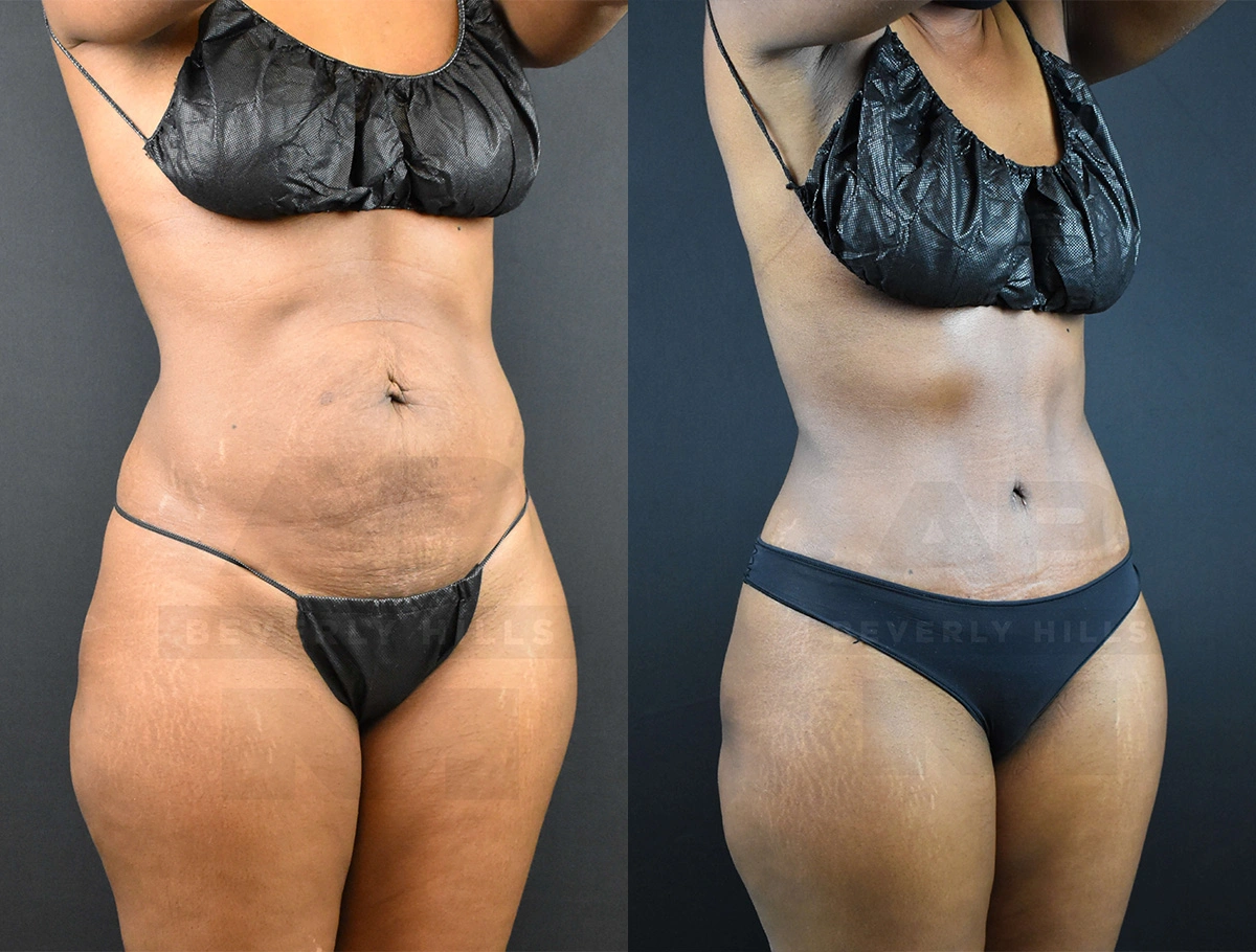 Real Patient Results of Dr. Andre P. Marshall providing Plastic Surgery services to his Beverly Hills & Los Angeles patients.