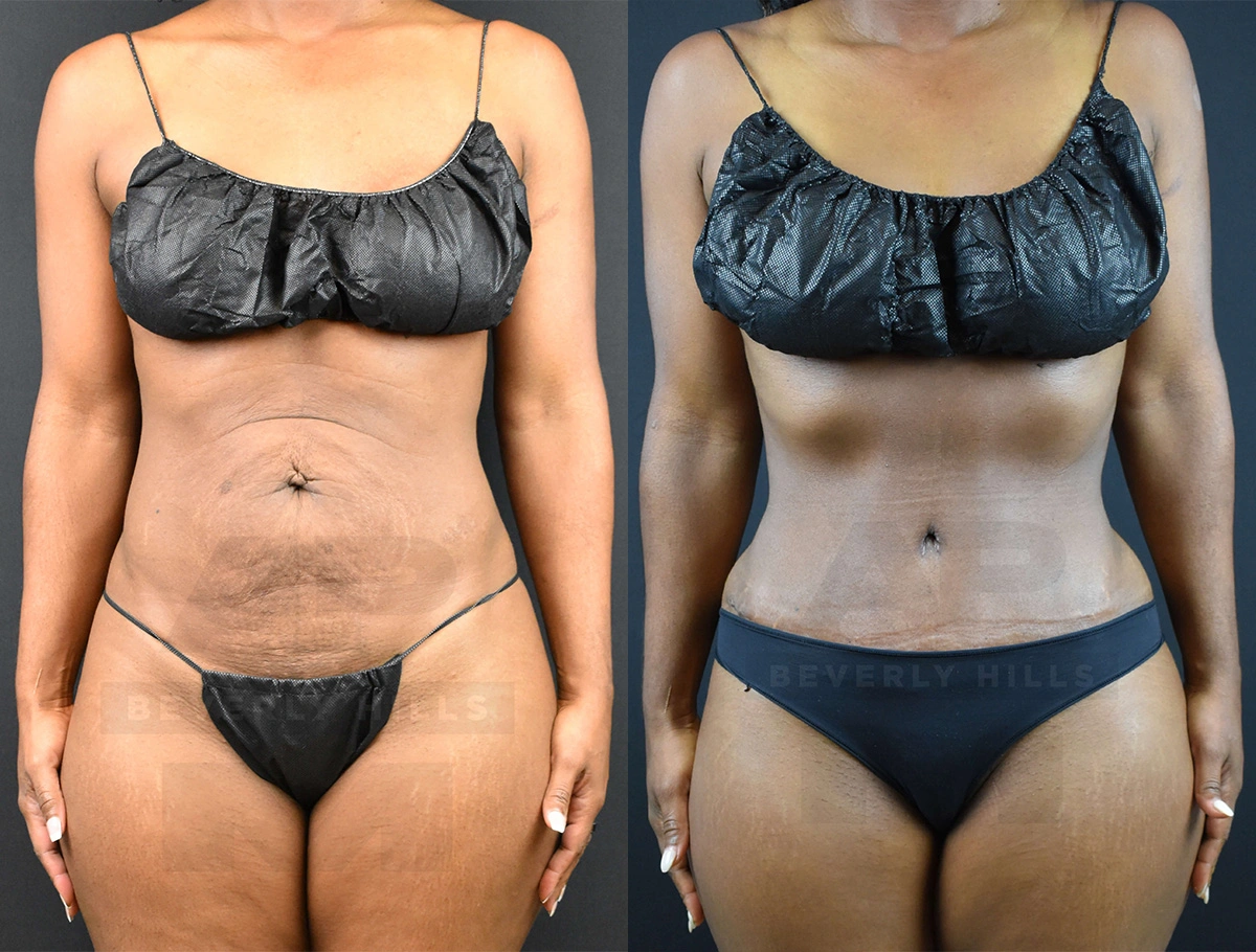 Real Patient Results of Dr. Andre P. Marshall providing Plastic Surgery services to his Beverly Hills & Los Angeles patients.