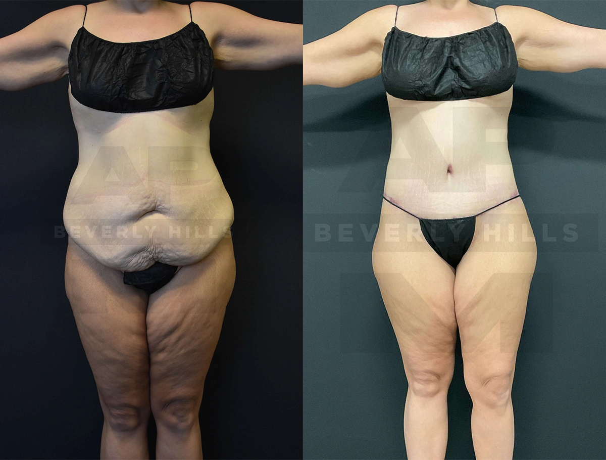 Real Patient Results of Dr. Andre P. Marshall providing Plastic Surgery services to his Beverly Hills & Los Angeles patients.