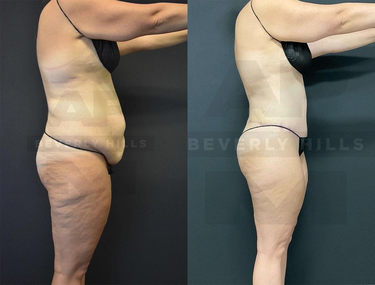 Real Patient Results of Dr. Andre P. Marshall providing Plastic Surgery services to his Beverly Hills & Los Angeles patients.