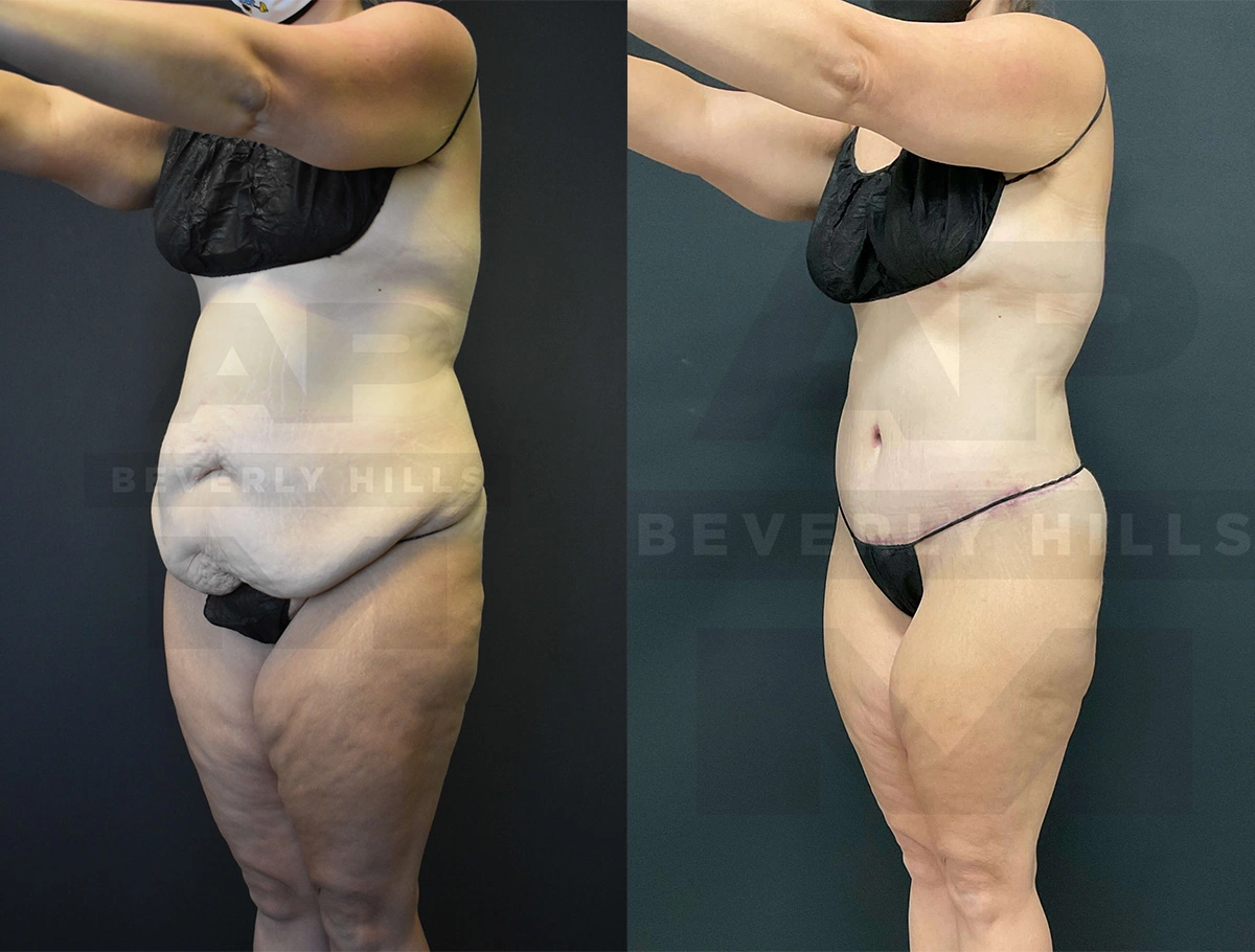 Real Patient Results of Dr. Andre P. Marshall providing Plastic Surgery services to his Beverly Hills & Los Angeles patients.