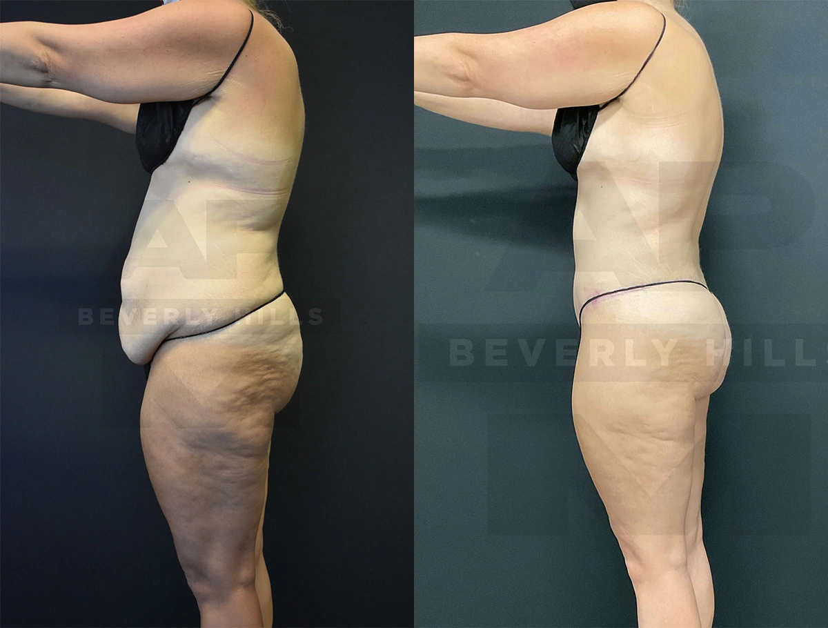 Real Patient Results of Dr. Andre P. Marshall providing Plastic Surgery services to his Beverly Hills & Los Angeles patients.