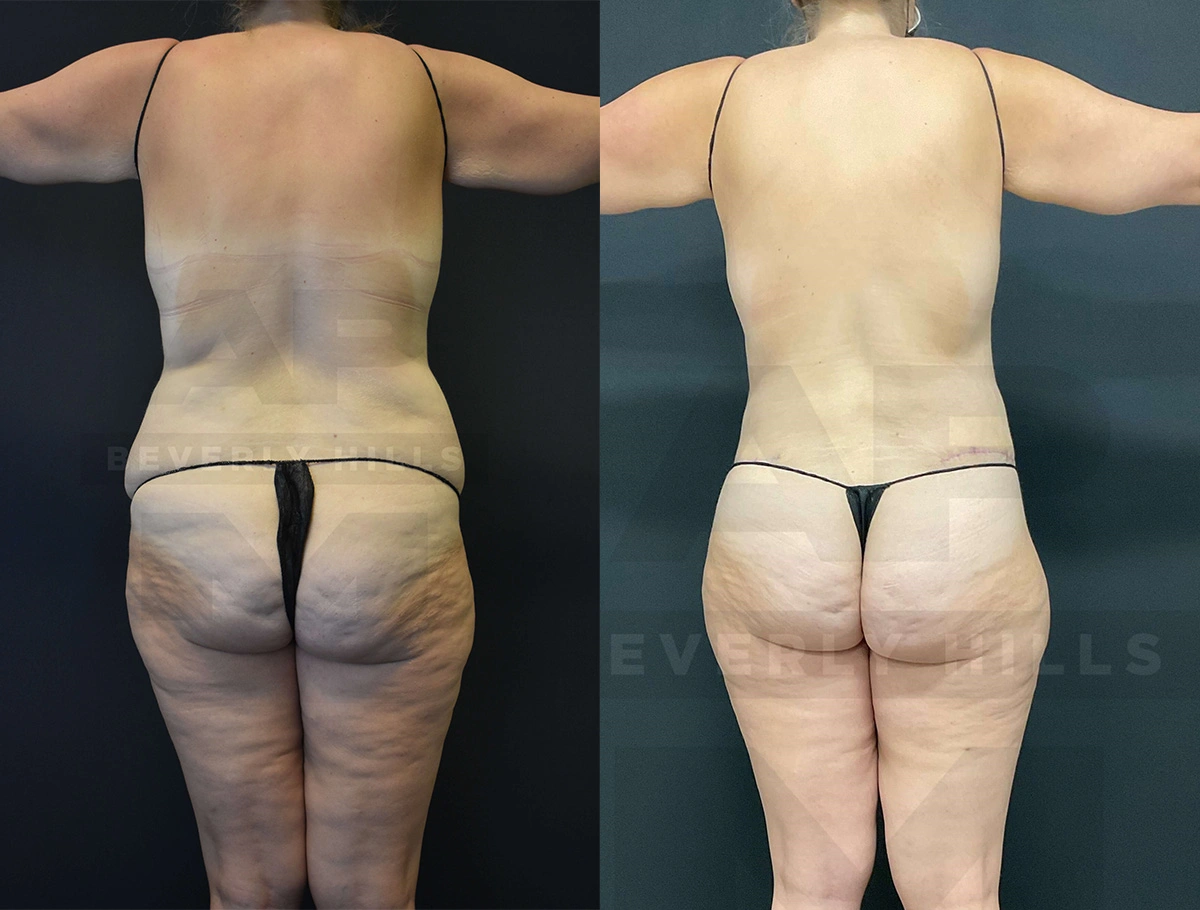 Real Patient Results of Dr. Andre P. Marshall providing Plastic Surgery services to his Beverly Hills & Los Angeles patients.