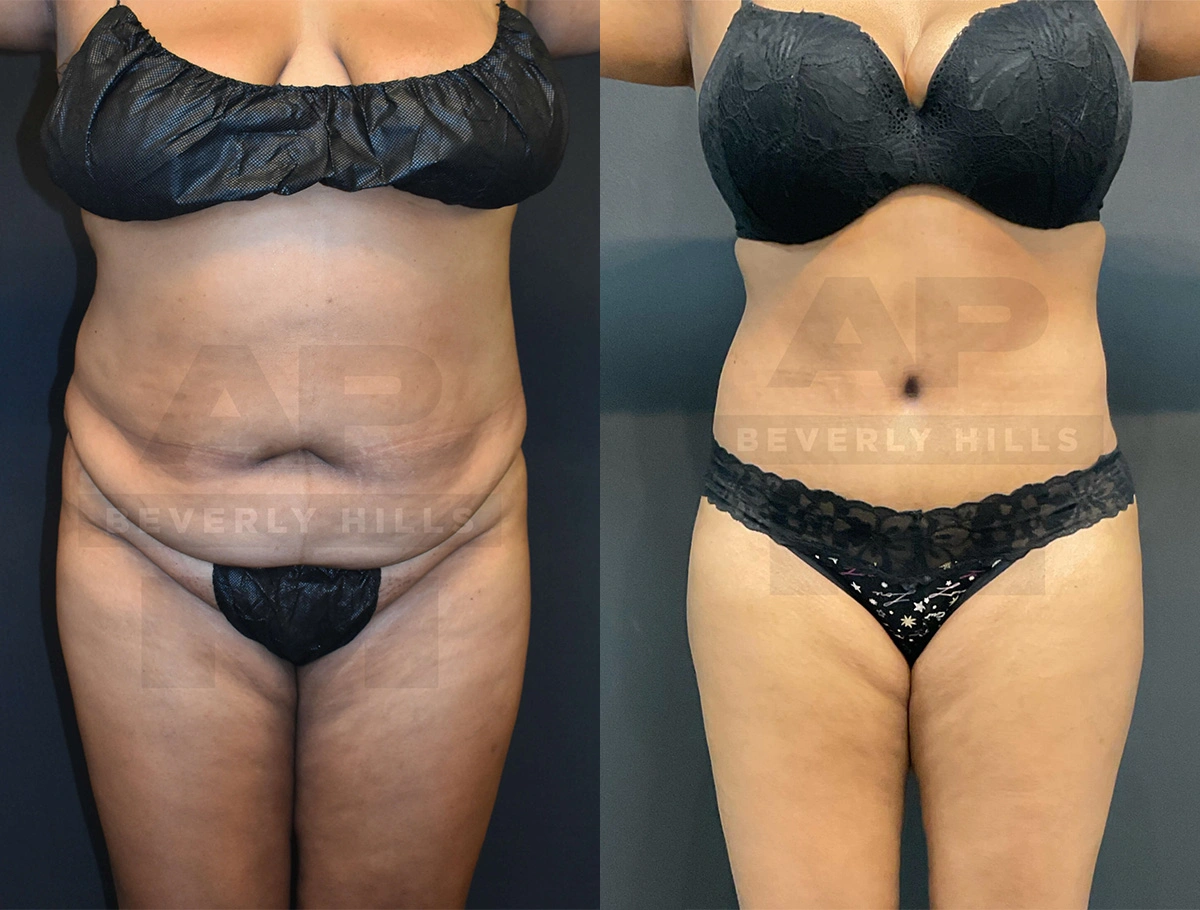 Real Patient Results of Dr. Andre P. Marshall providing Plastic Surgery services to his Beverly Hills & Los Angeles patients.