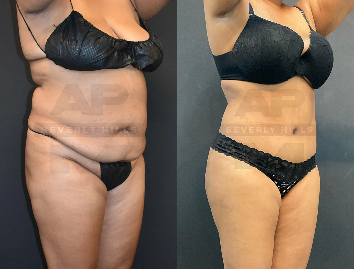 Real Patient Results of Dr. Andre P. Marshall providing Plastic Surgery services to his Beverly Hills & Los Angeles patients.