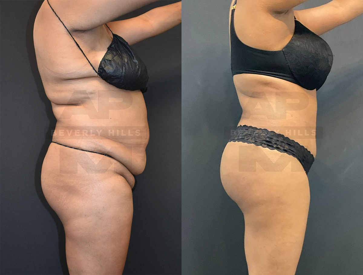 Real Patient Results of Dr. Andre P. Marshall providing Plastic Surgery services to his Beverly Hills & Los Angeles patients.