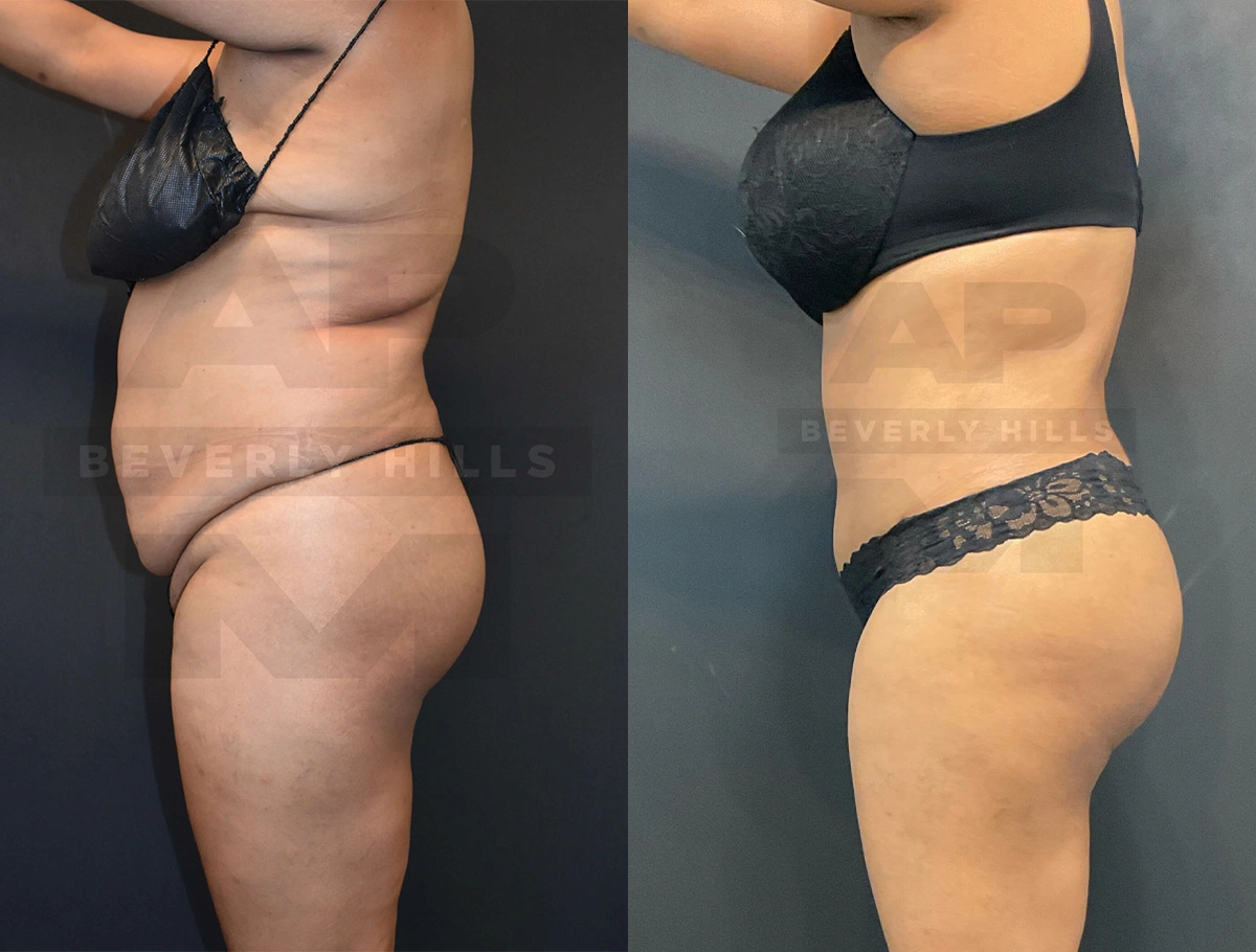 Real Patient Results of Dr. Andre P. Marshall providing Plastic Surgery services to his Beverly Hills & Los Angeles patients.