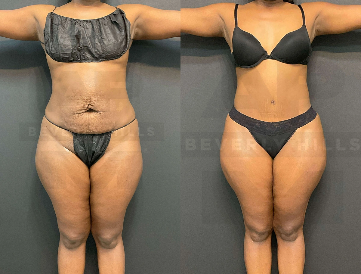 Real Patient Results of Dr. Andre P. Marshall providing Plastic Surgery services to his Beverly Hills & Los Angeles patients.