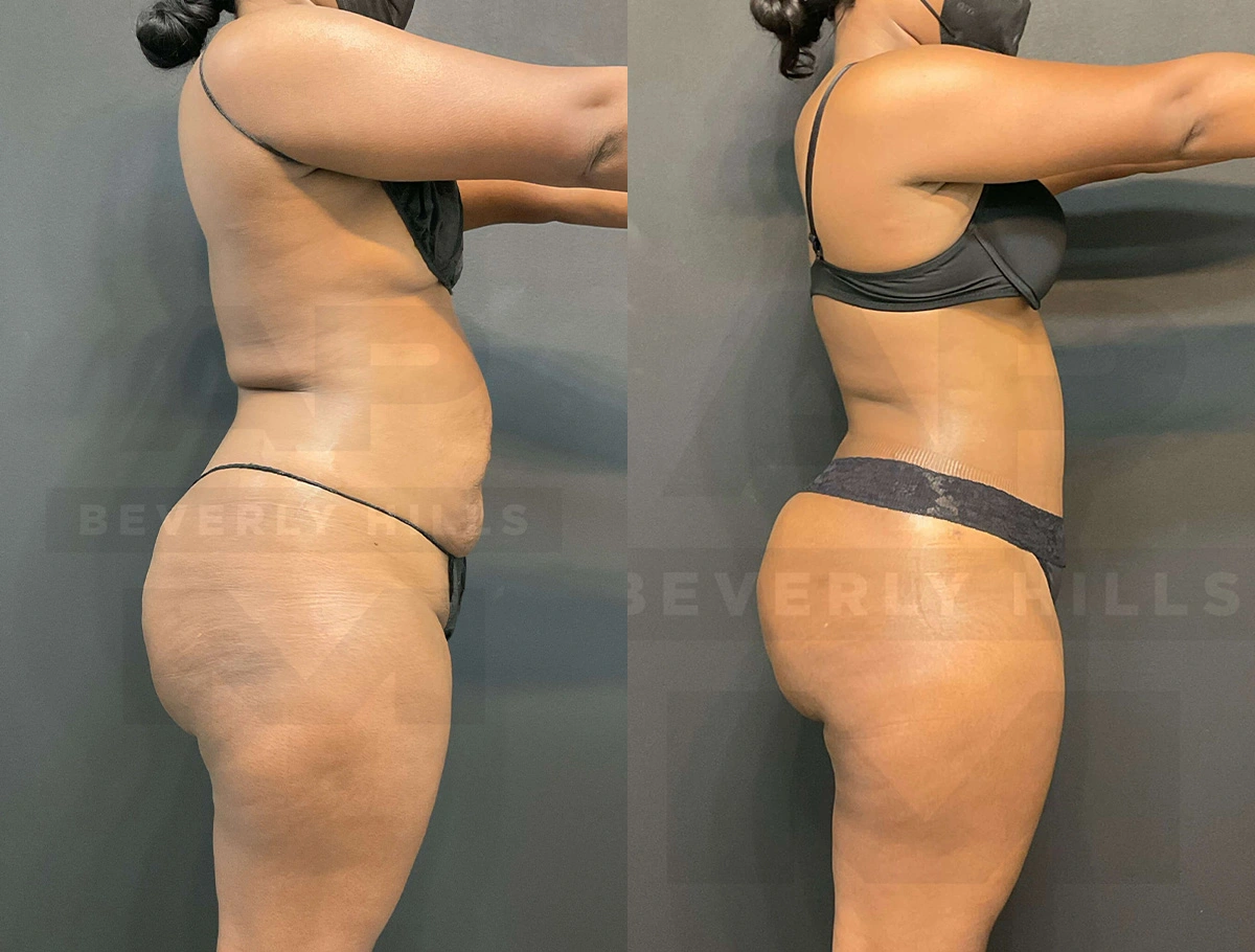 Real Patient Results of Dr. Andre P. Marshall providing Plastic Surgery services to his Beverly Hills & Los Angeles patients.