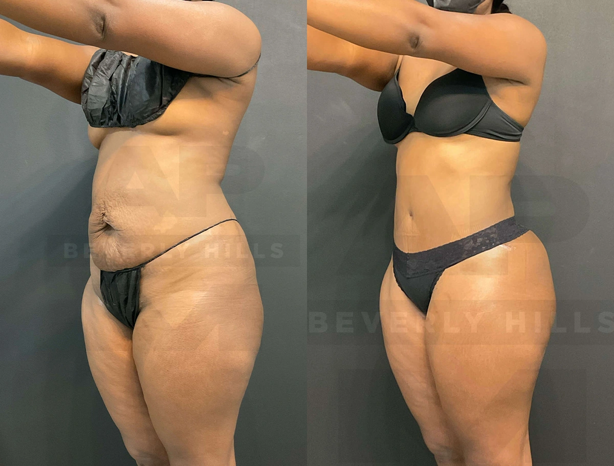 Real Patient Results of Dr. Andre P. Marshall providing Plastic Surgery services to his Beverly Hills & Los Angeles patients.