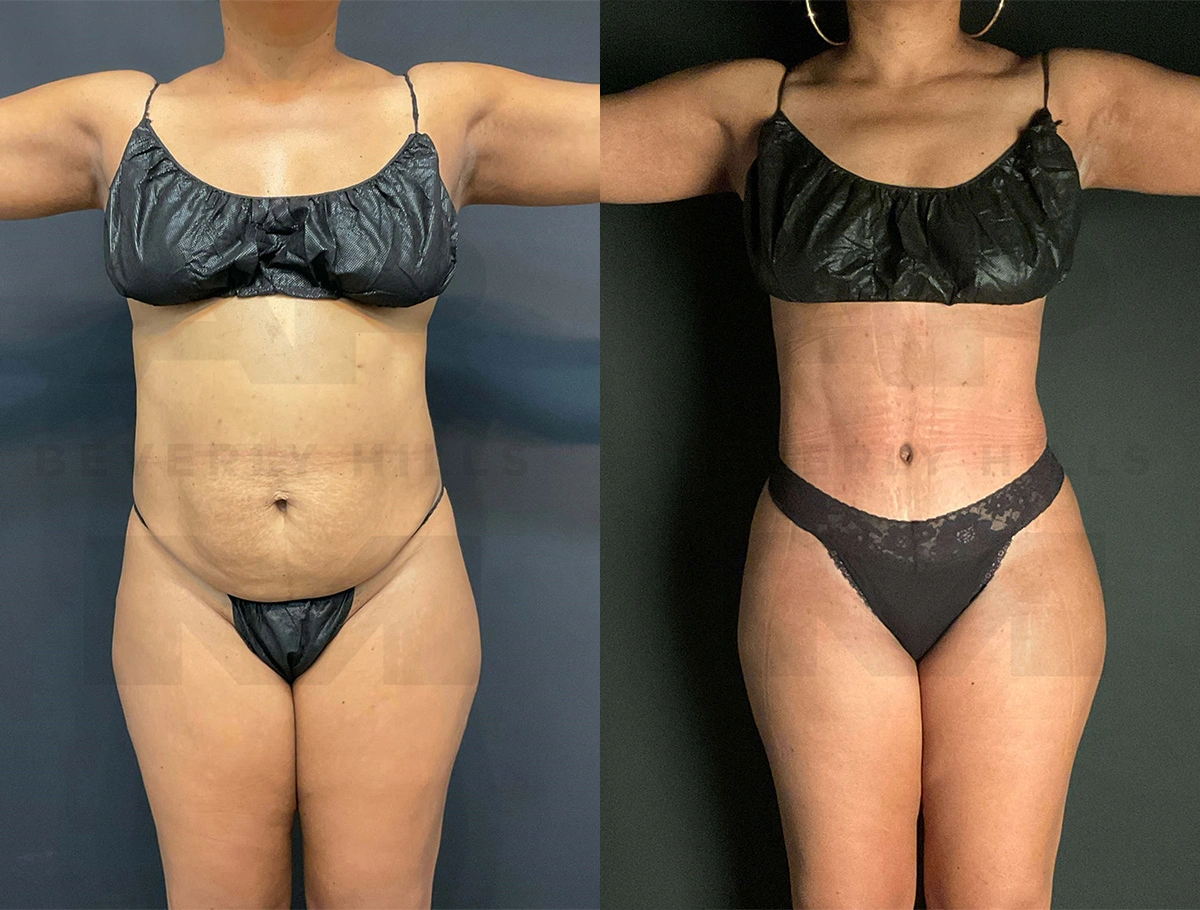 Real Patient Results of Dr. Andre P. Marshall providing Plastic Surgery services to his Beverly Hills & Los Angeles patients.