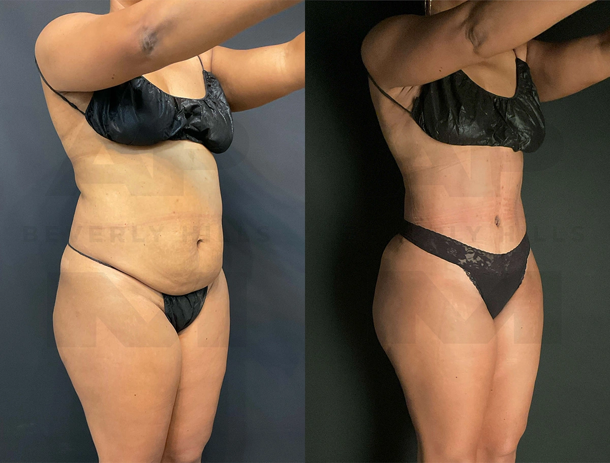 Real Patient Results of Dr. Andre P. Marshall providing Plastic Surgery services to his Beverly Hills & Los Angeles patients.