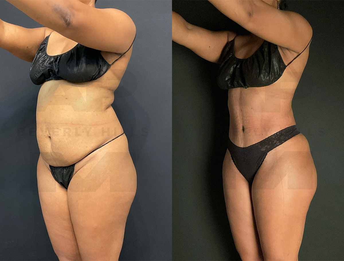 Real Patient Results of Dr. Andre P. Marshall providing Plastic Surgery services to his Beverly Hills & Los Angeles patients.