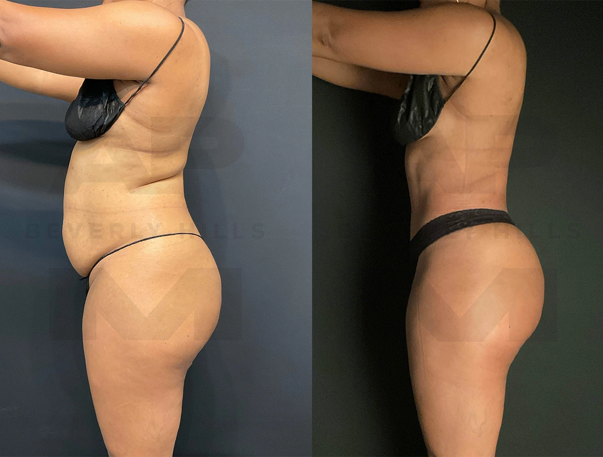 Real Patient Results of Dr. Andre P. Marshall providing Plastic Surgery services to his Beverly Hills & Los Angeles patients.