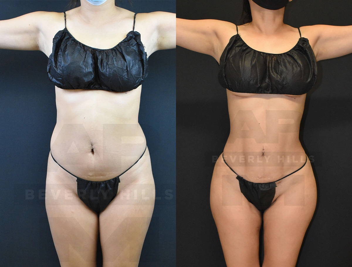 Real Patient Results of Dr. Andre P. Marshall providing Plastic Surgery services to his Beverly Hills & Los Angeles patients.