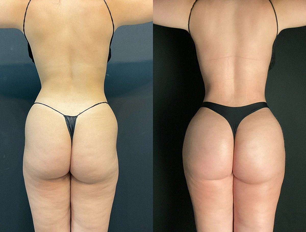 Real Patient Results by Dr. Marshall or Andrew P. Marshall Plastic Surgery serving Beverly Hills & Los Angeles, CA