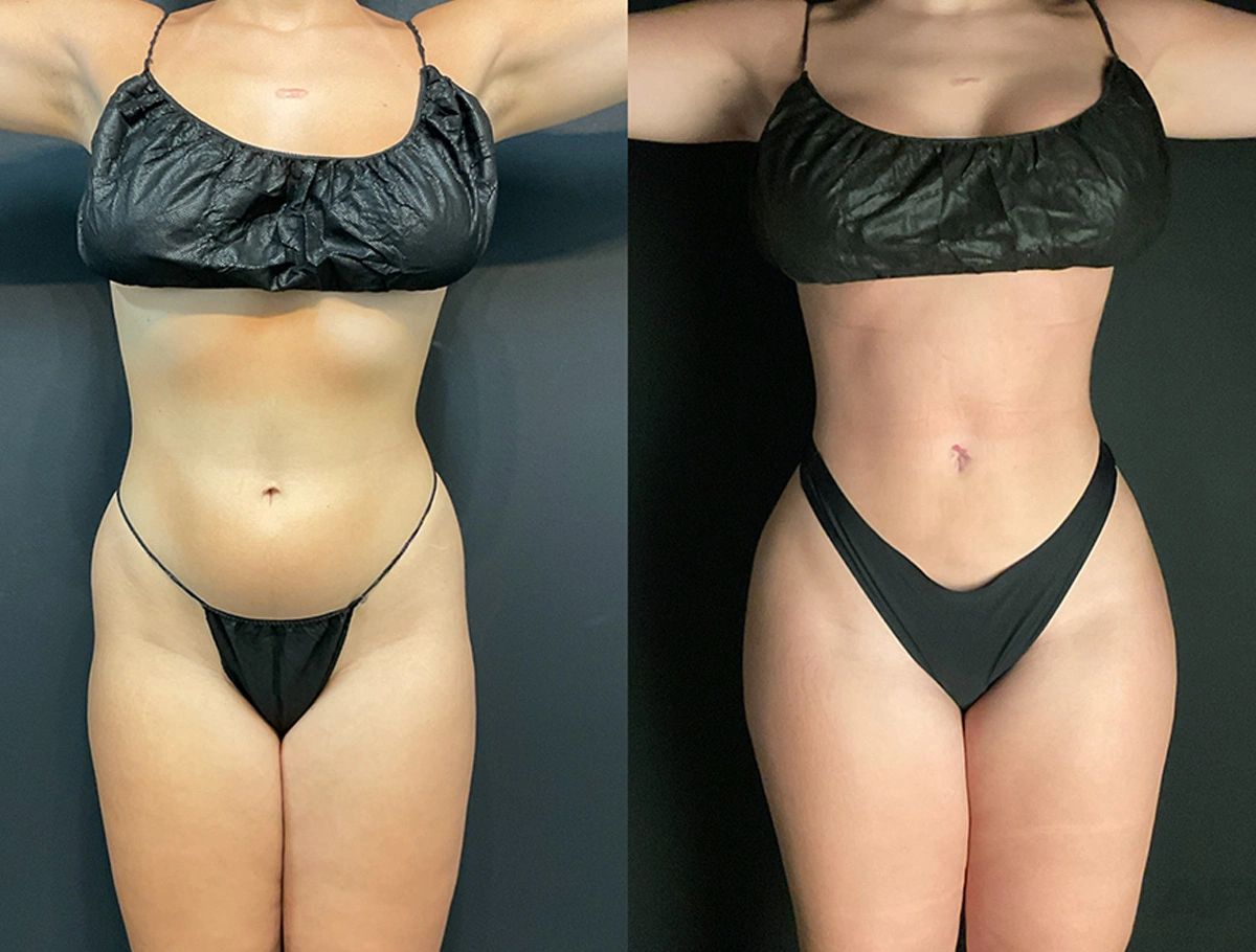 Real Patient Results by Dr. Marshall or Andrew P. Marshall Plastic Surgery serving Beverly Hills & Los Angeles, CA