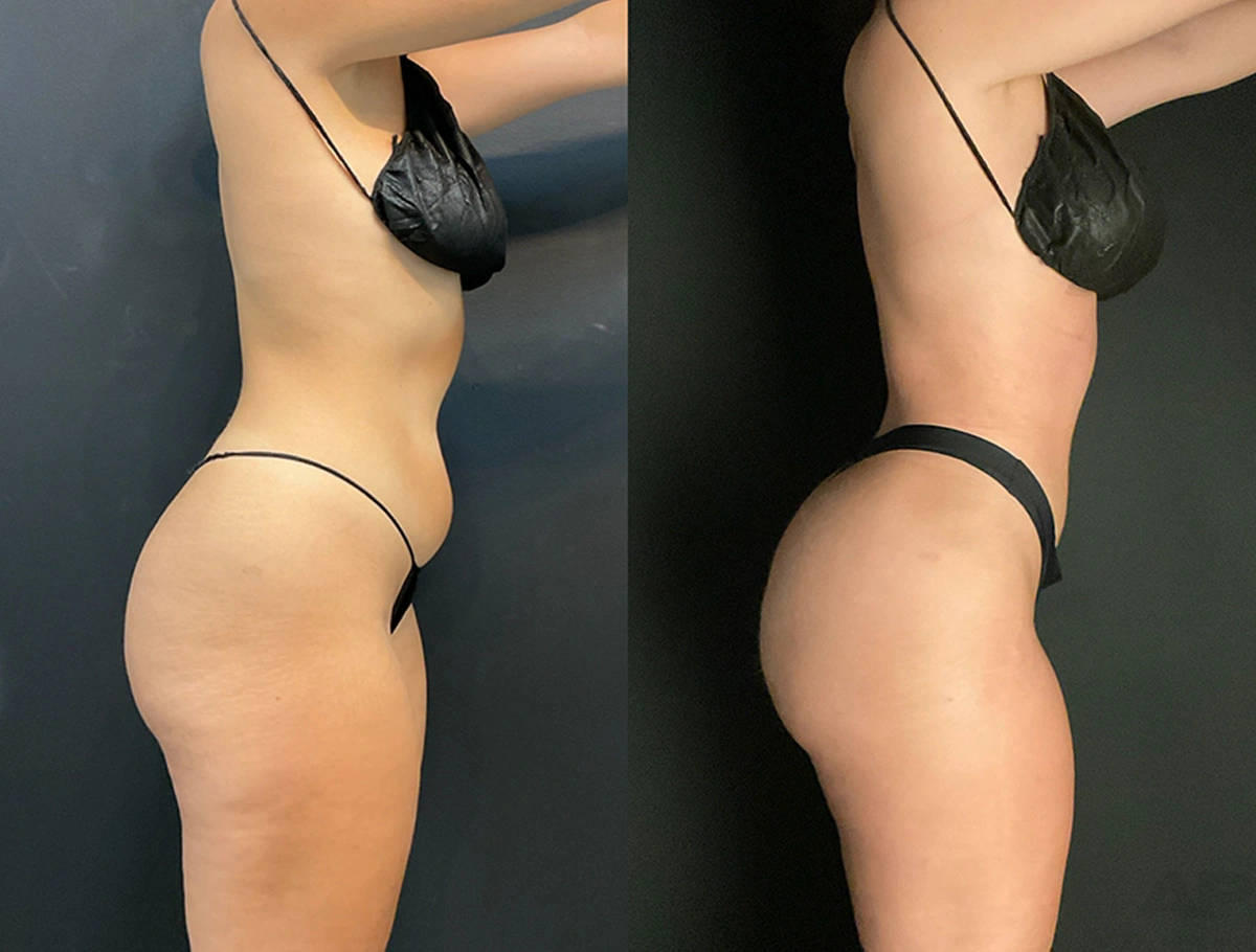 Real Patient Results by Dr. Marshall or Andrew P. Marshall Plastic Surgery serving Beverly Hills & Los Angeles, CA