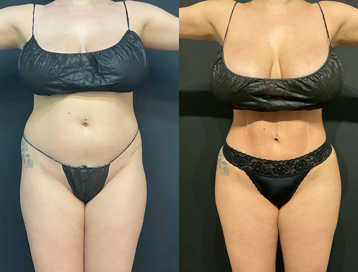 Real Patient Results by Dr. Marshall or Andrew P. Marshall Plastic Surgery serving Beverly Hills & Los Angeles, CA