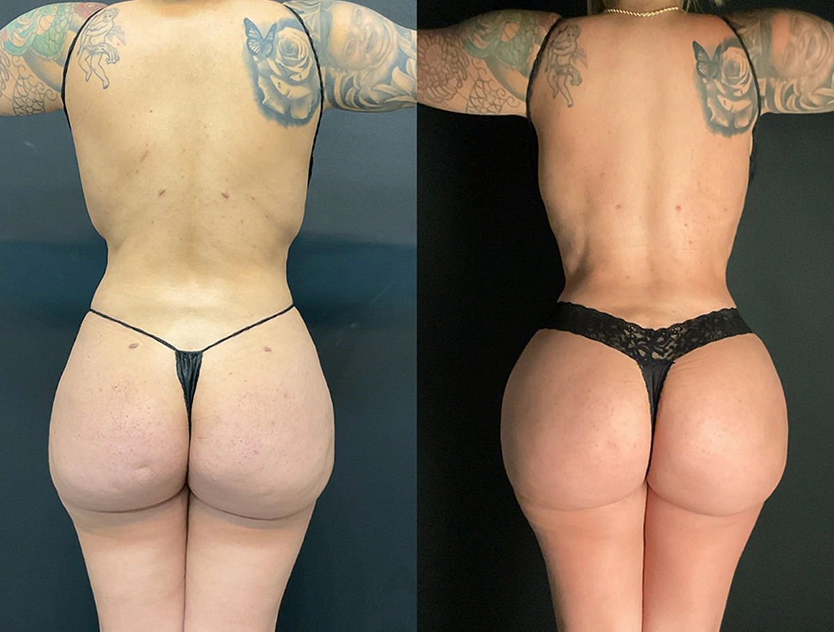 Real Patient Results by Dr. Marshall or Andrew P. Marshall Plastic Surgery serving Beverly Hills & Los Angeles, CA