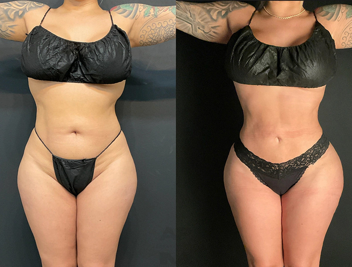 Real Patient Results by Dr. Marshall or Andrew P. Marshall Plastic Surgery serving Beverly Hills & Los Angeles, CA