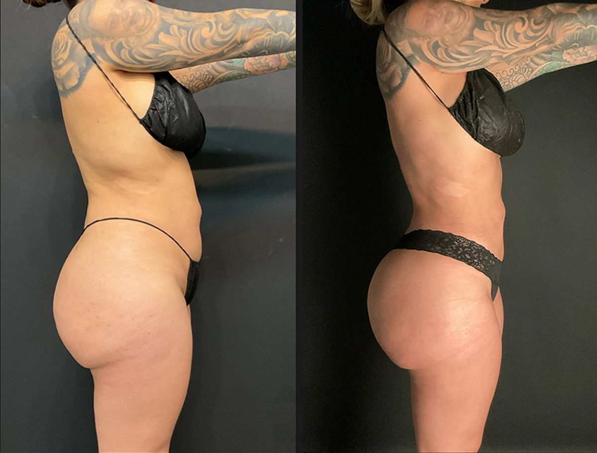 Real Patient Results by Dr. Marshall or Andrew P. Marshall Plastic Surgery serving Beverly Hills & Los Angeles, CA