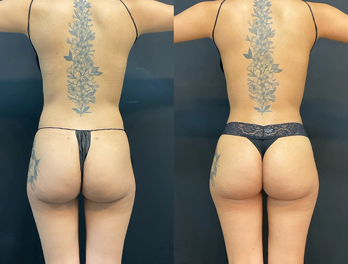 Real Patient Results by Dr. Marshall or Andrew P. Marshall Plastic Surgery serving Beverly Hills & Los Angeles, CA