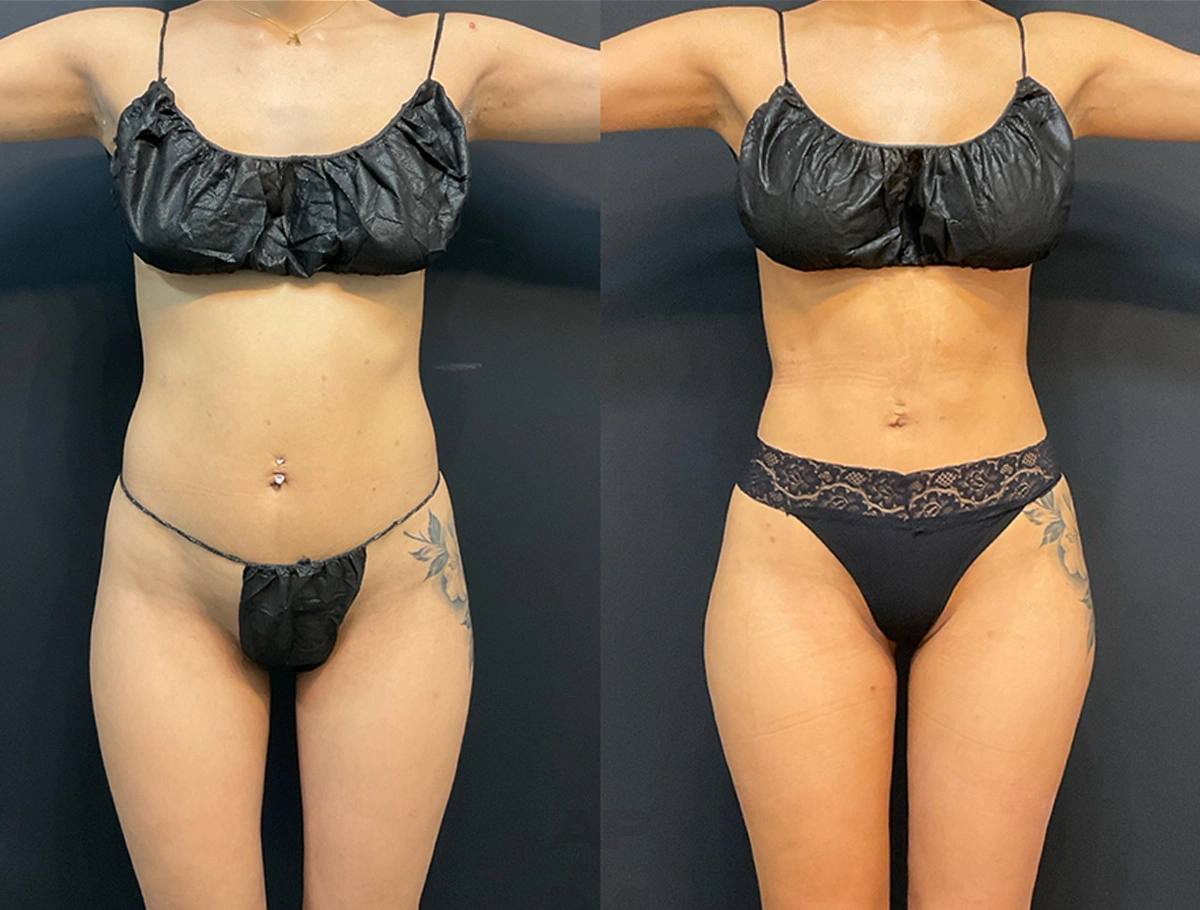 Real Patient Results by Dr. Marshall or Andrew P. Marshall Plastic Surgery serving Beverly Hills & Los Angeles, CA