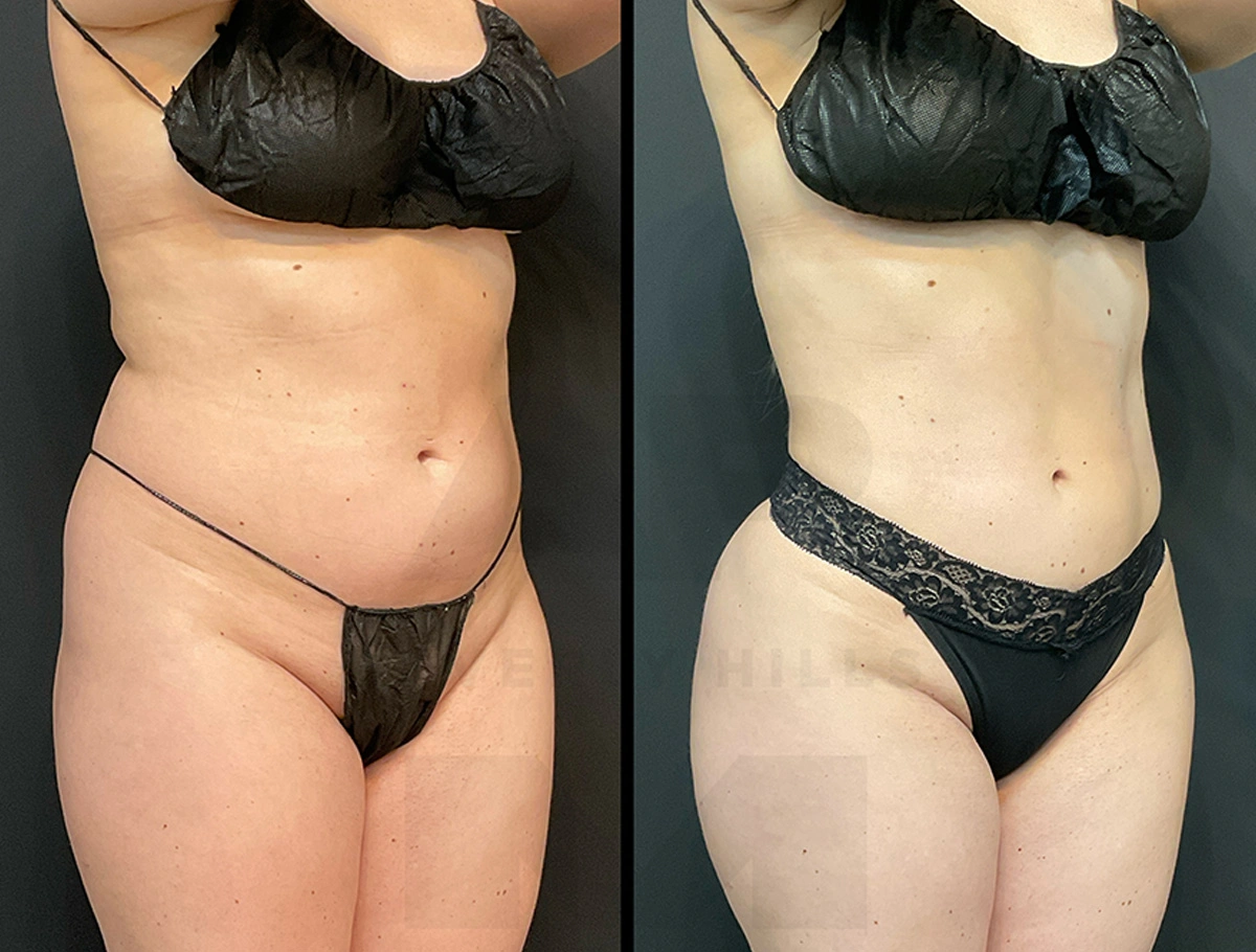 Real Patient Results by Dr. Marshall or Andrew P. Marshall Plastic Surgery serving Beverly Hills & Los Angeles, CA