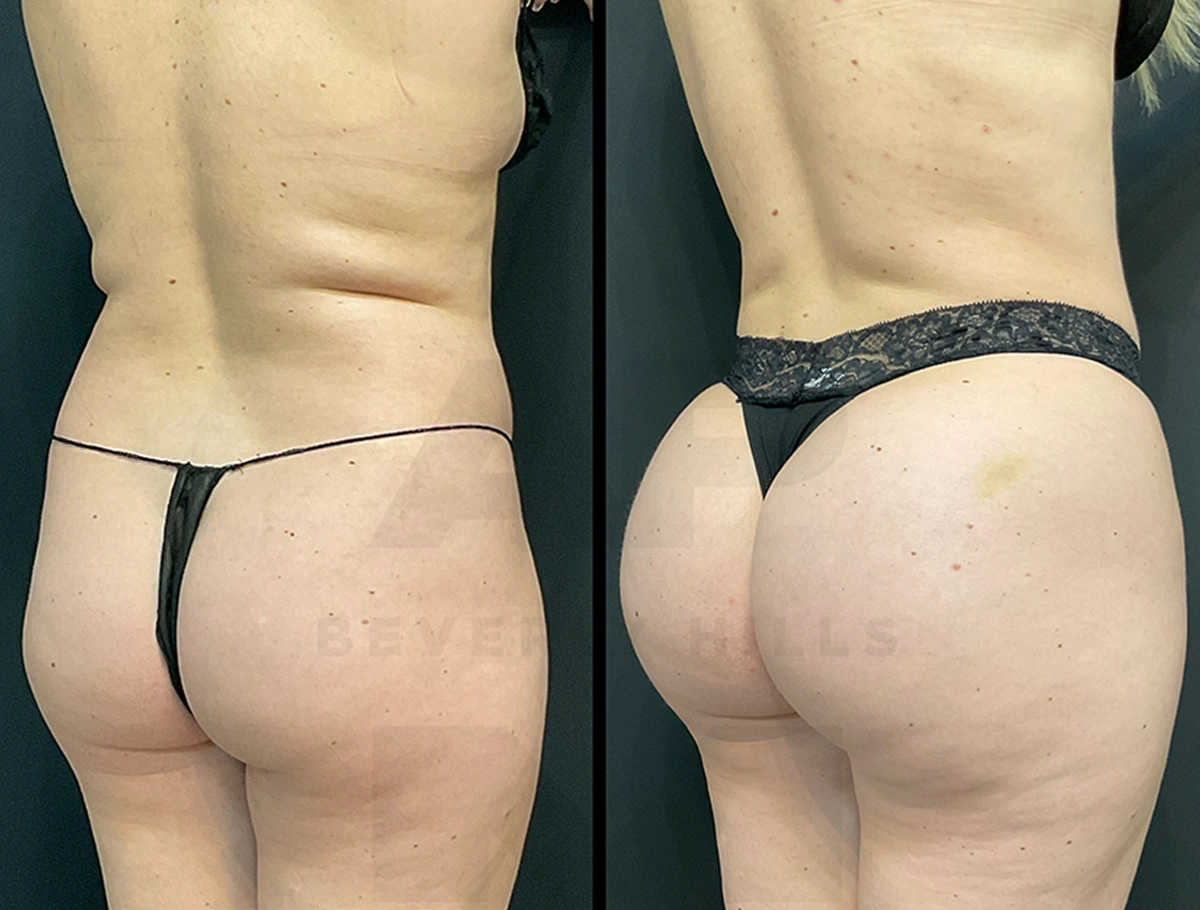 Real Patient Results by Dr. Marshall or Andrew P. Marshall Plastic Surgery serving Beverly Hills & Los Angeles, CA