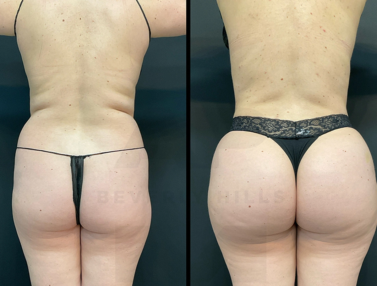 Real Patient Results by Dr. Marshall or Andrew P. Marshall Plastic Surgery serving Beverly Hills & Los Angeles, CA