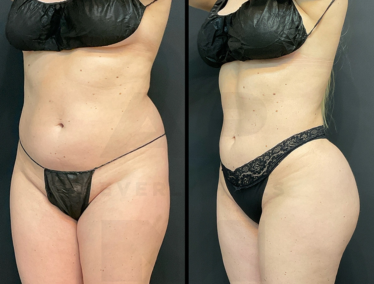 Real Patient Results by Dr. Marshall or Andrew P. Marshall Plastic Surgery serving Beverly Hills & Los Angeles, CA